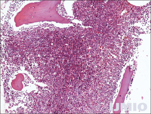 Bone marrow biopsy showing predominance of myeloid series (H and E stain, ×10) (Acknowledgment: Asmita Parhar, Anil Arora, and V K Arora, Department of Pathology, GTB Hospital and UCMS, Delhi)