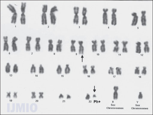 G-banding by trypsin using Giemsa shows reciprocal translocation between chromosomes 9 and 22 (Philadelphia Positive) (Acknowledgment: Reita Ghosh, Double Helix, Clinical Cytogenetics and Reproductive Immunology Center, Delhi)