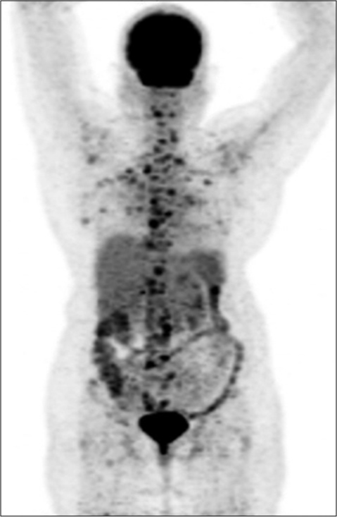 Baseline PET CT showed extensive disease with uptake in breast, nodes, bones.