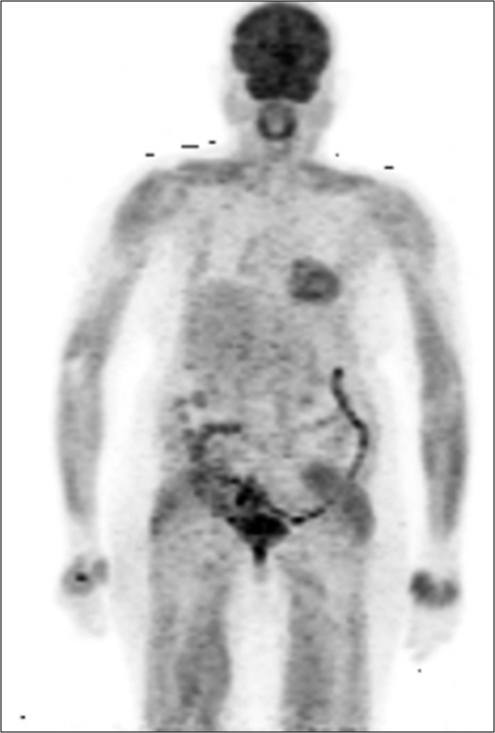 PET CT after 6 months of letrozole and palbociclib showing showing complete metabolic remission.