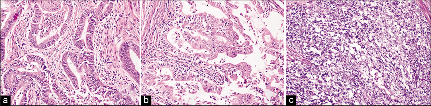 (a-c) Histomorphology of endometrioid adenocarcinoma Grades 1, 2, and 3, respectively. (H&E, ×200).