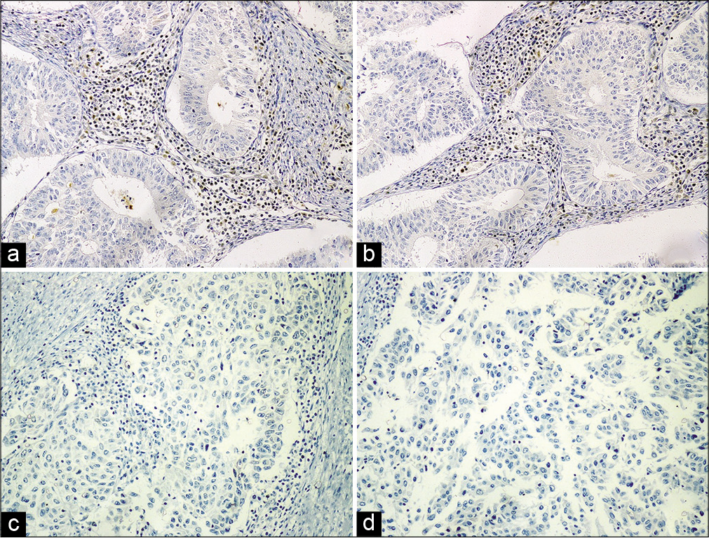 Immunohistochemical analysis of MMR proteins in endometrial carcinomas. (a) Loss of expression of MLH 1 in Grade 1 EEC; (b) loss of expression of MSH 2 in Grade 2 EEC; (c) loss of expression of MSH 6 in Grade 3 EEC; (d) loss of expression of PMS 2 in Grade 3 EEC. Positive internal control of lymphocytes with intact nuclear expression is seen in all figures.