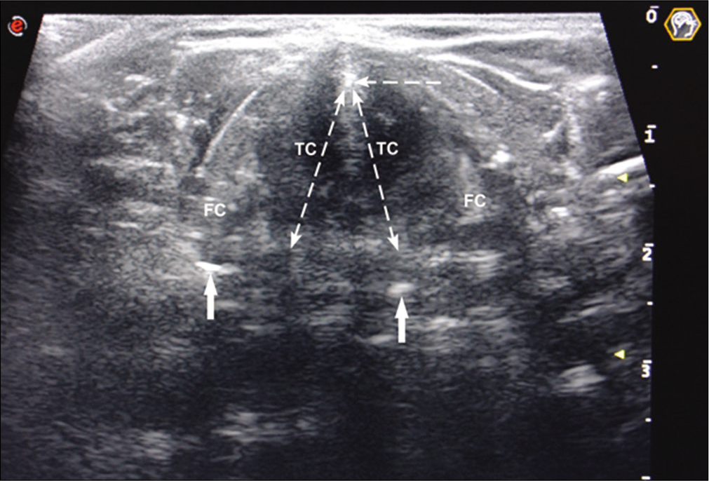 FC – False cords, TC – true cords, solid arrows – arytenoids, horizontal broken arrow – thyroid cartilage prominence.