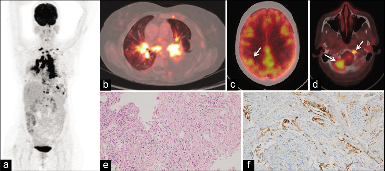 Baseline positron emission tomography-computed tomography (PET-CT) scan (a) Maximum intensity projection (MIP) image (b) FDG- avid mediastinal lymph nodes and left hilar mass (c) FDG-avid solitary lesion in the right parietal lobe (white arrow) (d) FDG-avid lesions in the right petroclival and left anterior basiocciput regions of skull base (white arrows) (e) photomicrographs of bronchoscopic lung biopsy showing tumor cells arranged in glandular pattern in subepithelium and surrounded by desmoplastic stroma (hematoxylin and eosin stain, ×200) (f) Tumor cells showing strong cytoplasmic positivity for anaplastic lymphoma kinase by immunohistochemistry (D5F3 clone, Roche® Ventana®, ×200).