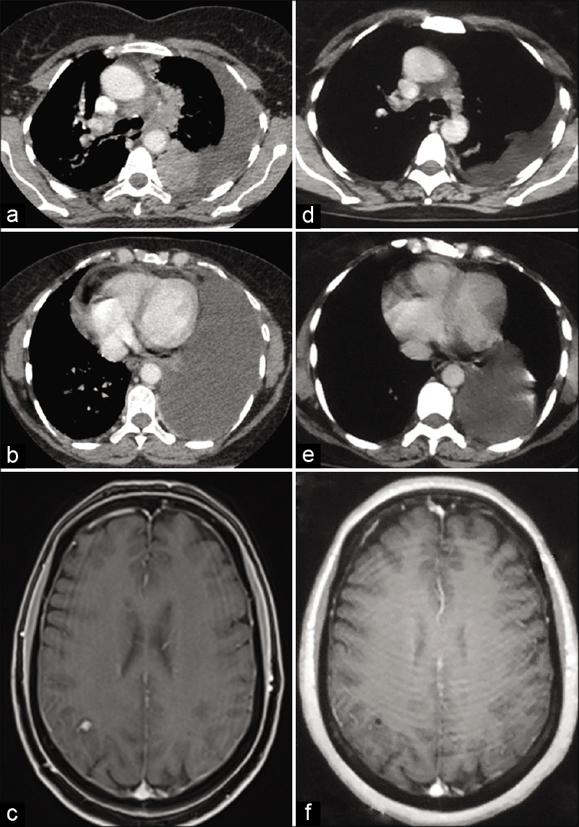 Baseline images (before initiation of alectinib treatment) (a and b) contrast-enhanced axial computed tomography (CECT) scan of thorax showing left hilar mass, mediastinal lymphadenopathy, left-sided pleural effusion, and pericardial effusion and (c) Axial T1-weighted fat saturated post-gadolinium magnetic resonance image (MRI) of the brain showing 7 × 6 mm lesion in the right parietal lobe. Post-treatment images (following alectinib therapy) (d and e) CECT scan of thorax showing partial resolution of the left hilar mass, lymphadenopathy, and pleuropericardial effusion and (f) axial T1-weighted post-gadolinium MRI of brain showing resolution of the right parietal lobe lesion.