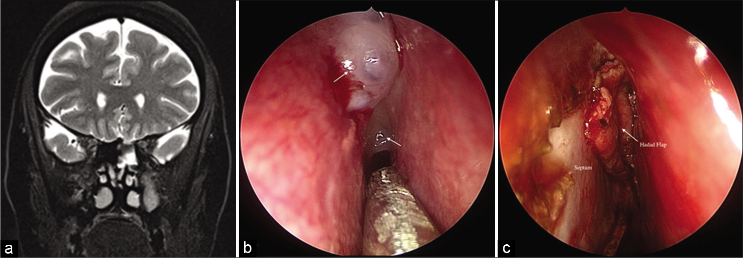 (a) Coronal T2-weighted magnetic resonance images showing contiguous fluid signal intensity filling the left ethmoid with a defect in its roof. (b) Intraoperative image showing two defects with meningoceles (white arrows) in the cribriform plate. (c) Intraoperative image showing repair of the defects with fat and vascularized nasoseptal (Hadad) flap (white arrow) after plasma-mediated ablation of meningoceles.