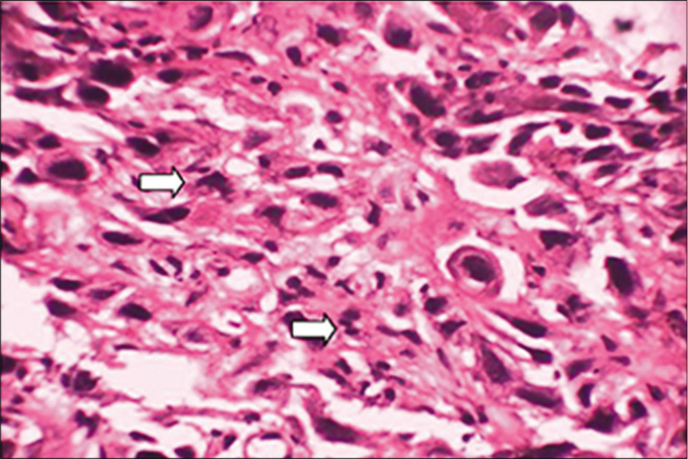 Photomicrograph showing widespread dissociation of dysplastic epithelial cells with complete loss of intercellular adhesion, mitotic figures, and abnormal mitoses PDSC (×40) (arrows shows the mitotic figures and abnormal mitoses).