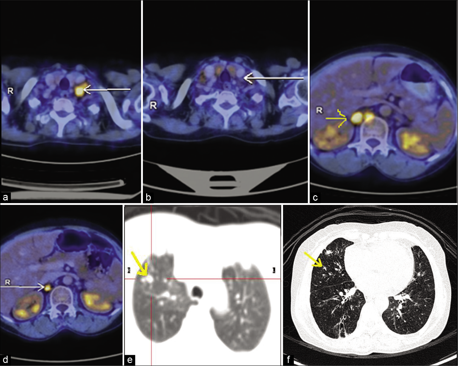 (a) PET scan image of metastatic left supraclavicular lymph node before starting immunotherapy (arrow shows FDG avid cervical lymph node). (b) Metabolic resolution with reduction in size of metastatic left supraclavicular lymph node on response evaluation PET scan after three cycles of pembrolizumab (arrow shows cervical lymph node complete metabolic resolution). (c) PET scan image of metastatic para-aortic, aortocaval, and retrocrural lymph nodes before starting immunotherapy (arrow shows FDG avid para-aortic lymph node). (d) Metabolic resolution with reduction in size of metastatic para-aortic, aortocaval, and retrocrural lymph nodes on response evaluation PET scan after three cycles of pembrolizumab (arrow shows reduced size and FDG avidity). (e) PET scan images of metastatic nodules scattered in both lungs before starting immunotherapy (arrow shows non-FDG-avid lung nodule). (f) Reduction in size and number of fdg non-avid subcentimetric nodules scattered in both lungs on response evaluation PET scan after three cycles of pembrolizumab (arrow shows reduced size of non-FDG-avid lung nodule).