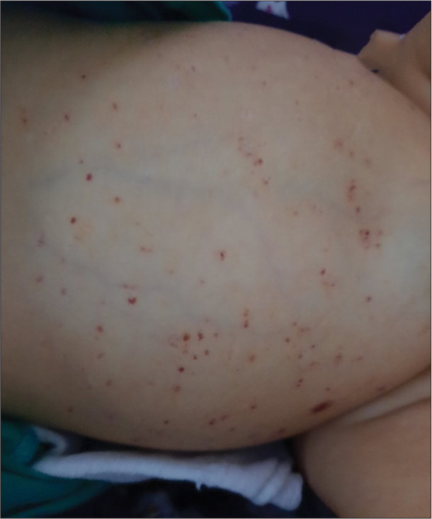 Erythematous skin rash and abdominal distension secondary to massive hepatosplenomegaly.