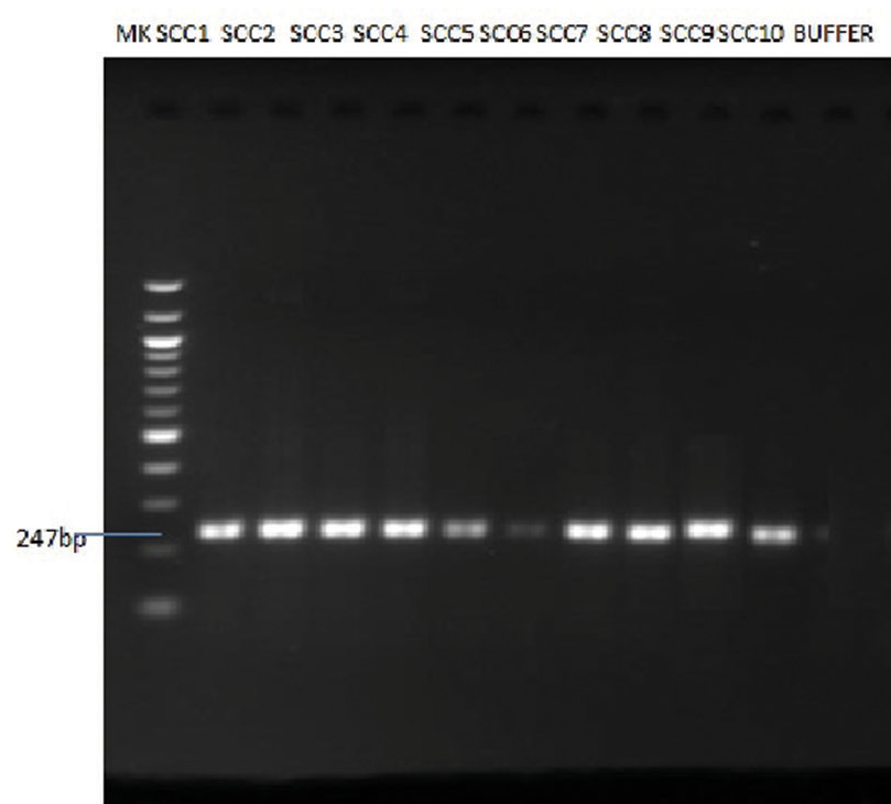 Agarose gel showing the positive amplification of retinoblastoma (RB) gene amplified from DNA isolated from ten patients using RB gene-specific primers.