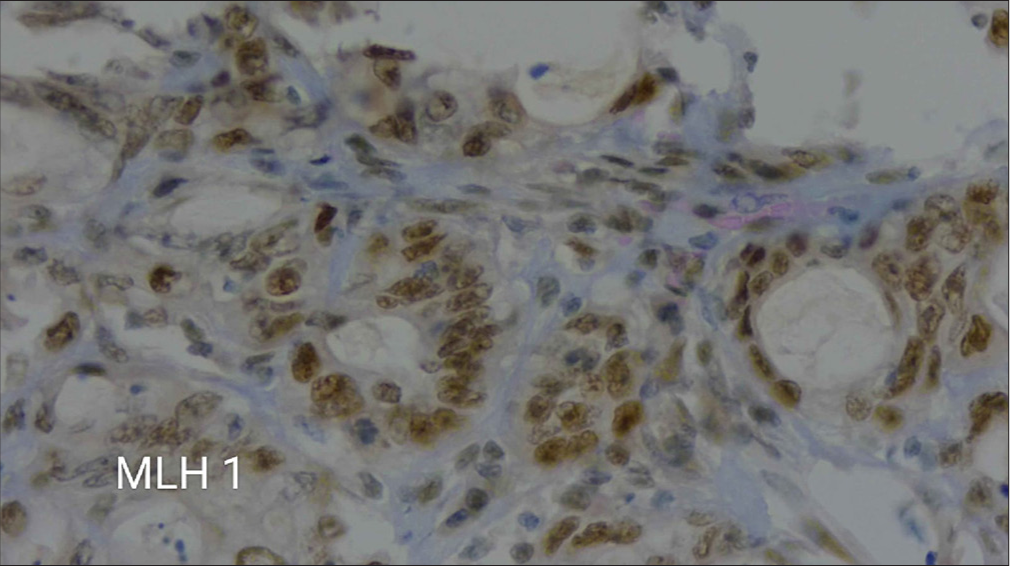 A microscopic view at 40× magnification showing immunohistochemical staining for MLH1.