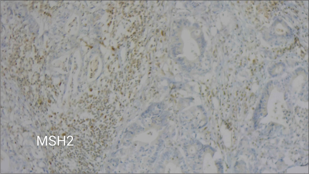 A microscopic view at 10× magnification showing weak immunohistochemical staining for MSH2.