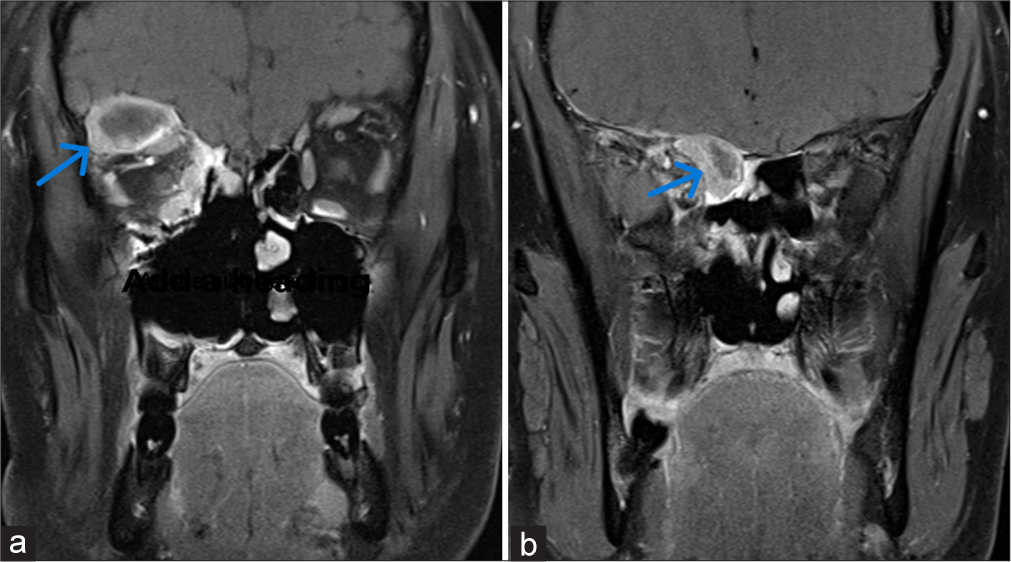(a-b) Post-contrast T1-weighted coronal image showing heterogeneously enhancing mass lesion, the blue arrow shows invasion of (a) intraorbital extraconal compartment of right orbit and (b) right posterior ethmoidal air cells.