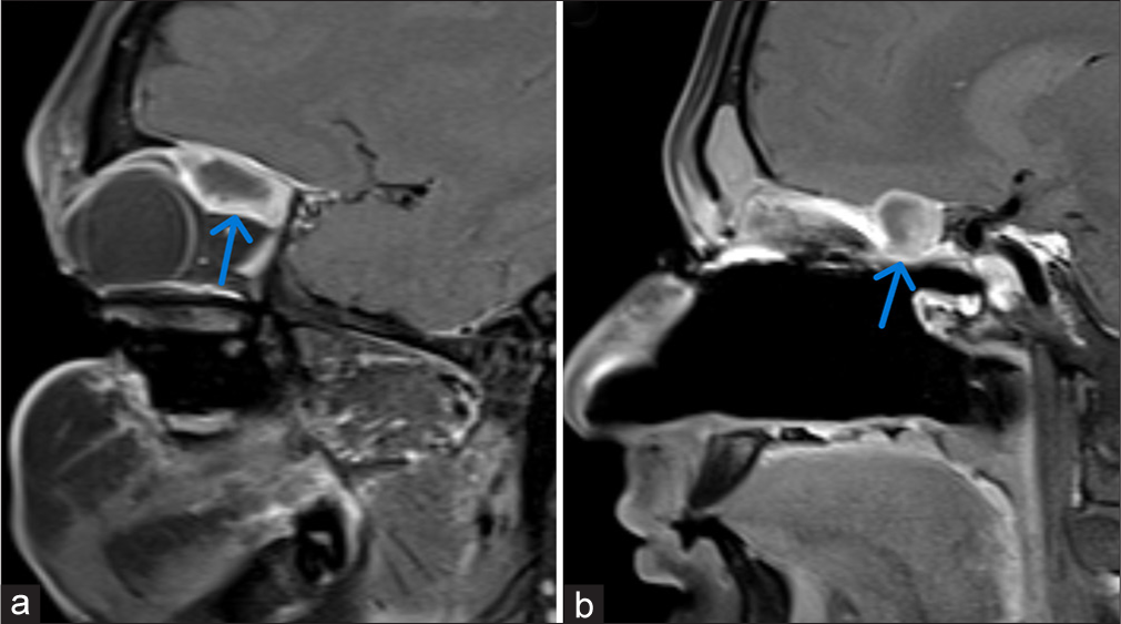 (a-b) Post-contrast T1-weighted sagittal image showing heterogeneously enhancing mass lesion, the blue arrow shows invasion of (a) intraorbital extraconal compartment of right orbit and (b) right posterior ethmoidal air cells.
