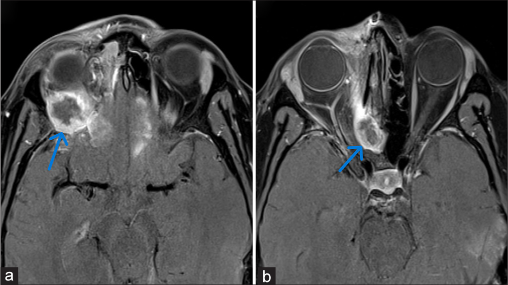 (a-b) Post-contrast T1-weighted axial image showing heterogeneously enhancing mass lesion, the blue arrow shows invasion of (a) intraorbital extraconal compartment of right orbit and (b) right posterior ethmoidal air cells.