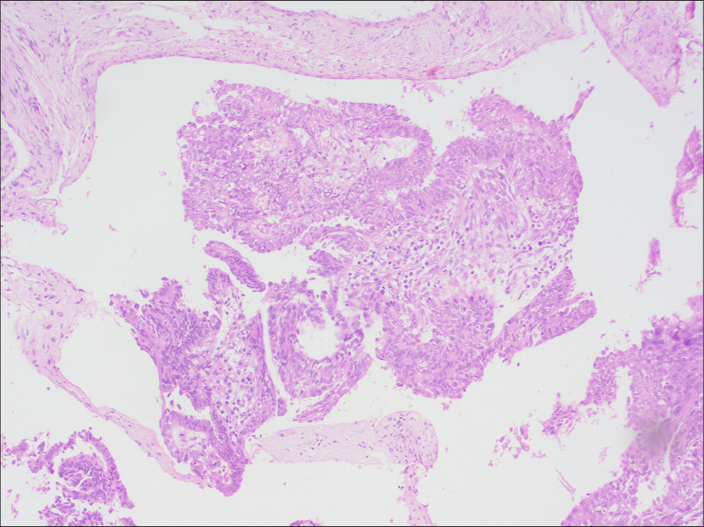 Hematoxylin and eosin staining showing squamous differentiated cells mixed with poorly differentiated tumor cells with a high nuclear–cytoplasmic ratio (magnification × 40).