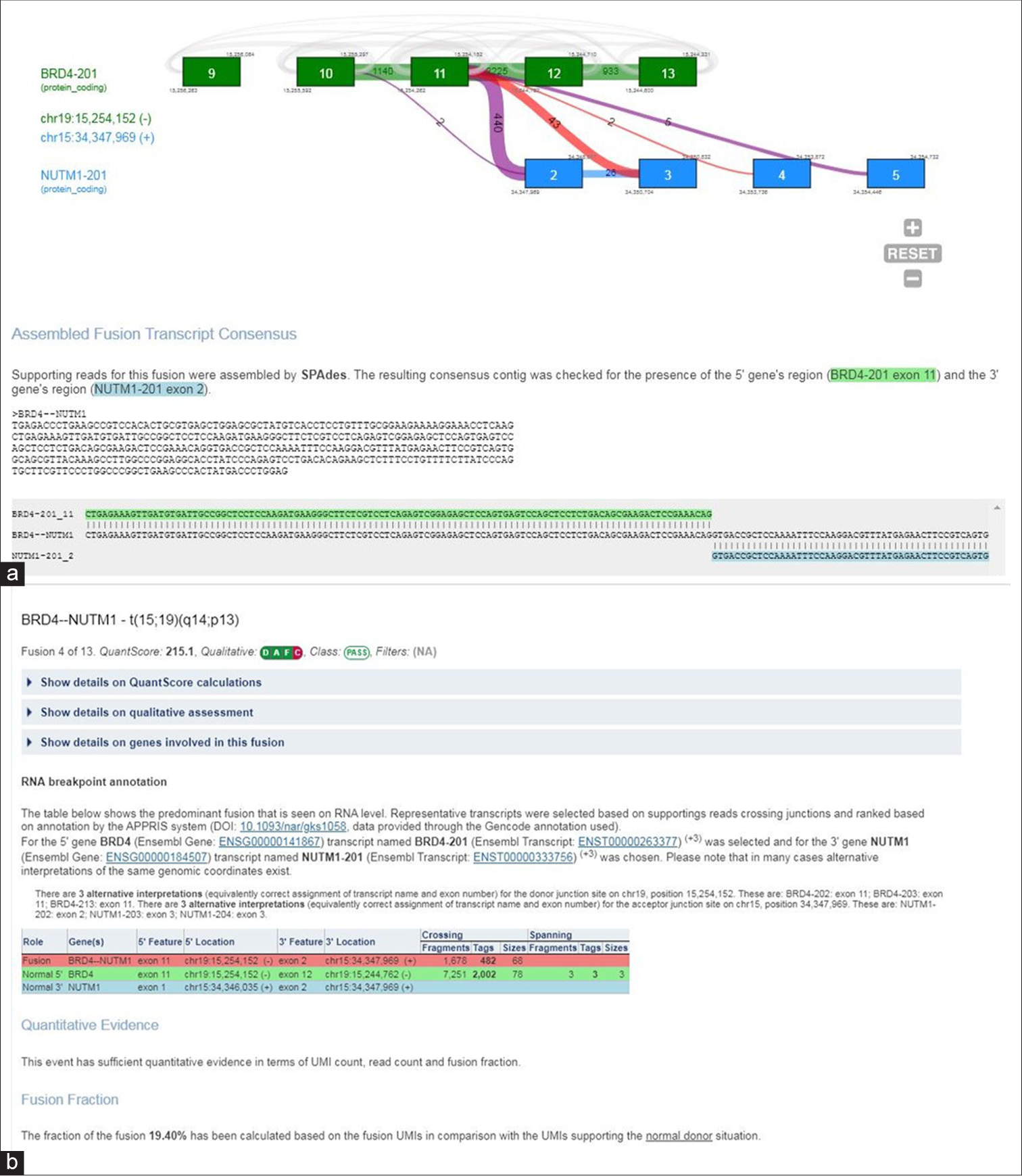 (a and b) Next-generation sequence report showing NUTM1-BRD4 mutation.