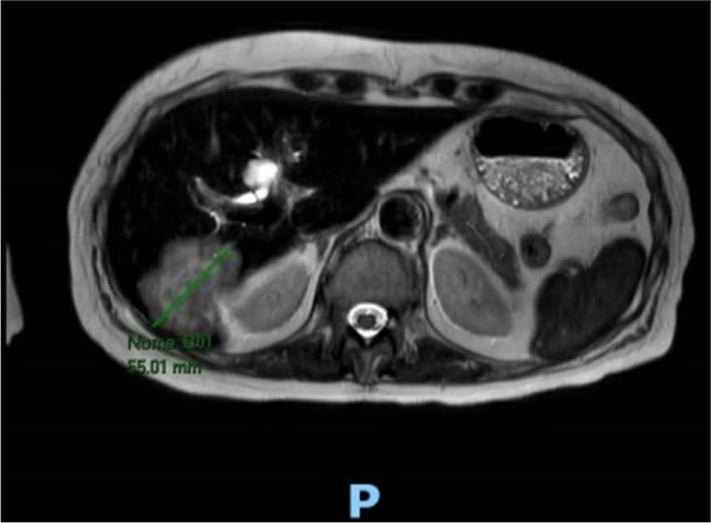 Magnetic resonance imaging scan showing lesions in the liver before the oncologic treatment. The green arrow shows the size of the mass seen in the liver at segment VII/VI measuring approximately 55mm.