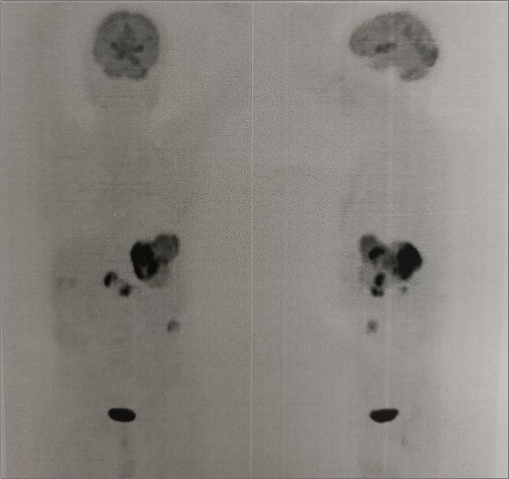 Pre-therapy fluorodeoxy glucose (FDG) positron emission tomography scan of the patient with hepatocellular carcinoma showing a large disease in the left lobe of liver with para-aortic nodes.